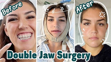 jaw surgery reddit|orthognathic surgery recovery blogs.